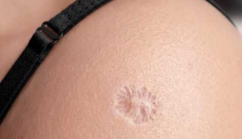 Reason so many people have this exact same scar