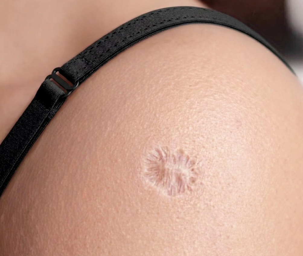 Reason so many people have this exact same scar
